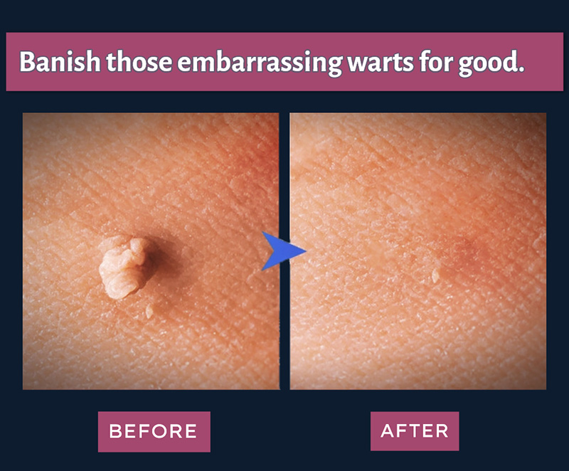Banish those embarrassing warts for good - Before and After